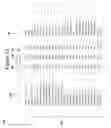 Fig. 12 - Pattern recognition system for quantifying the likelihood of the contribution of multiple possible forms of chronic disease to patient reported dyspnea