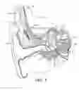 Fig. 02 - Cochlear Implant Electrode Insertion Support Device