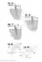 Fig. 02 - Biological unit removal tools and methods