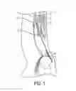 Fig. 02 - Method of mending a groin defect