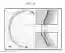 Fig. 49 - Instruments and methods for the implantation of cell-seeded substrates