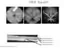Fig. 50 - Instruments and methods for the implantation of cell-seeded substrates