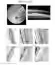 Fig. 53 - Instruments and methods for the implantation of cell-seeded substrates