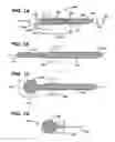 Fig. 02 - Methods and devices for repairing and anchoring damaged tissue