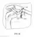 Fig. 08 - Surgical fastening