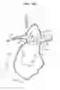 Fig. 07 - Vascular prosthesis for treating aneurysms