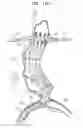 Fig. 35 - Vascular prosthesis for treating aneurysms