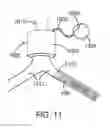 Fig. 09 - Devices and methods for assisting valve function, replacing venous valves, and predicting valve treatment success