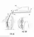 Fig. 08 - Root canal probe tool and method of removing a broken instrument fragment from a root canal