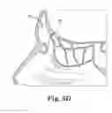 Fig. 09 - ELECTROSURGICAL DEVICE AND METHOD
