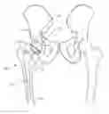 Fig. 01 - Methods and systems for preparing the acetabulum to receive an acetabular component in a hip replacement surgical procedure