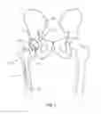 Fig. 02 - Methods and systems for preparing the acetabulum to receive an acetabular component in a hip replacement surgical procedure