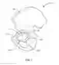 Fig. 07 - Methods and systems for preparing the acetabulum to receive an acetabular component in a hip replacement surgical procedure