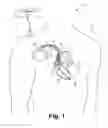Fig. 02 - Criteria for optimal electrical resynchronization derived from multipolar leads or multiple electrodes during biventricular pacing