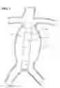 Fig. 02 - Lumbar ostia occlusion devices and methods of deploying the same