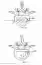 Fig. 33 - INTERBODY IMPLANTS AND GRAFT DELIVERY SYSTEMS