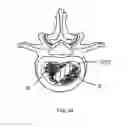 Fig. 34 - INTERBODY IMPLANTS AND GRAFT DELIVERY SYSTEMS