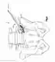 Fig. 03 - Flexible vertebral spacer