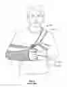 Fig. 07 - Arm immobilization device and associated methods