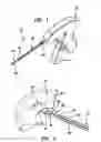 Fig. 02 - Arthroscopic meniscal repair systems and methods
