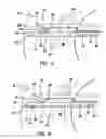 Fig. 04 - Arthroscopic meniscal repair systems and methods