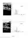 Fig. 09 - Orientation-aware average intensity histogram to indicate object boundary depth in ultrasound images