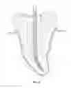 Fig. 05 - Cross-Fluted Endodontic Instrument