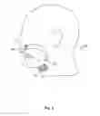 Fig. 03 - Implant encapsulation