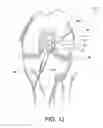 Fig. 07 - Bone tendon constructs and methods of tissue fixation