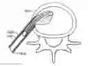 Fig. 01 - Prosthetic spinal disk nucleus