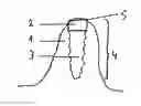 Fig. 01 - IMPLANT AND DENTAL PROSTHESES SYSTEM