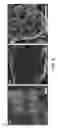 Fig. 08 - Antimicrobial polymer-graphene-silver nanocomposite