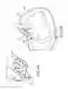 Fig. 07 - Cardiac tissue anchoring devices, methods, and systems for treatment of congestive heart failure and other conditions