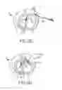 Fig. 09 - Cardiac tissue anchoring devices, methods, and systems for treatment of congestive heart failure and other conditions