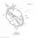 Fig. 07 - Guidable intravascular blood pump and related methods