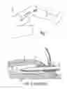 Fig. 02 - SINGLE-PASS ENDOSCOPIC VESSEL HARVESTING
