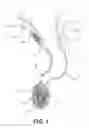 Fig. 02 - Minimally invasive biomaterial injection system