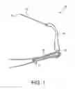 Fig. 02 - Bunion repair using suture-button construct