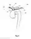 Fig. 08 - Linked deflection devices, systems and methods for the prevention of stroke