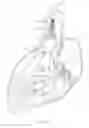 Fig. 08 - Methods and apparatus for endovascularly replacing a heart valve