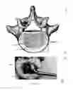 Fig. 02 - Expandable trials