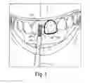 Fig. 02 - Protective wax for bleached teeth