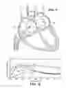 Fig. 07 - System for identifying the location of a device within a patients body in order to locate the fossa ovalis for trans-septal procedures