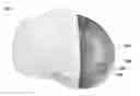 Fig. 01 - Patient specific bone preparation for consistent effective fixation feature engagement