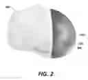 Fig. 03 - Patient specific bone preparation for consistent effective fixation feature engagement
