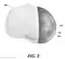 Fig. 04 - Patient specific bone preparation for consistent effective fixation feature engagement