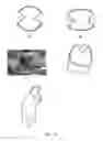 Fig. 09 - Anti-clogging device for a vacuum-assisted, tissue removal system