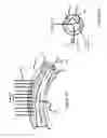 Fig. 02 - System and methods which remove material from blood vessel walls