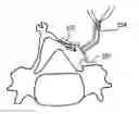 Fig. 01 - Laminoplasty fixation devices