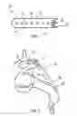 Fig. 02 - Laminoplasty fixation devices